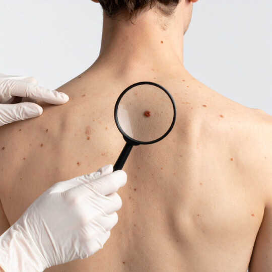 Onderzoek naar huidskleurmeting - Nederlandse Vereniging van Huidtherapeuten