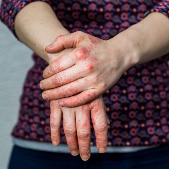 De Generieke NVH-Zorgmodule is gepubliceerd! - Nederlandse Vereniging van Huidtherapeuten