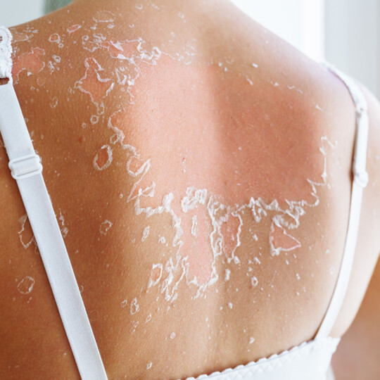 IKNL Rapportage ‘Huidkanker in Nederland’ - Nederlandse Vereniging van Huidtherapeuten