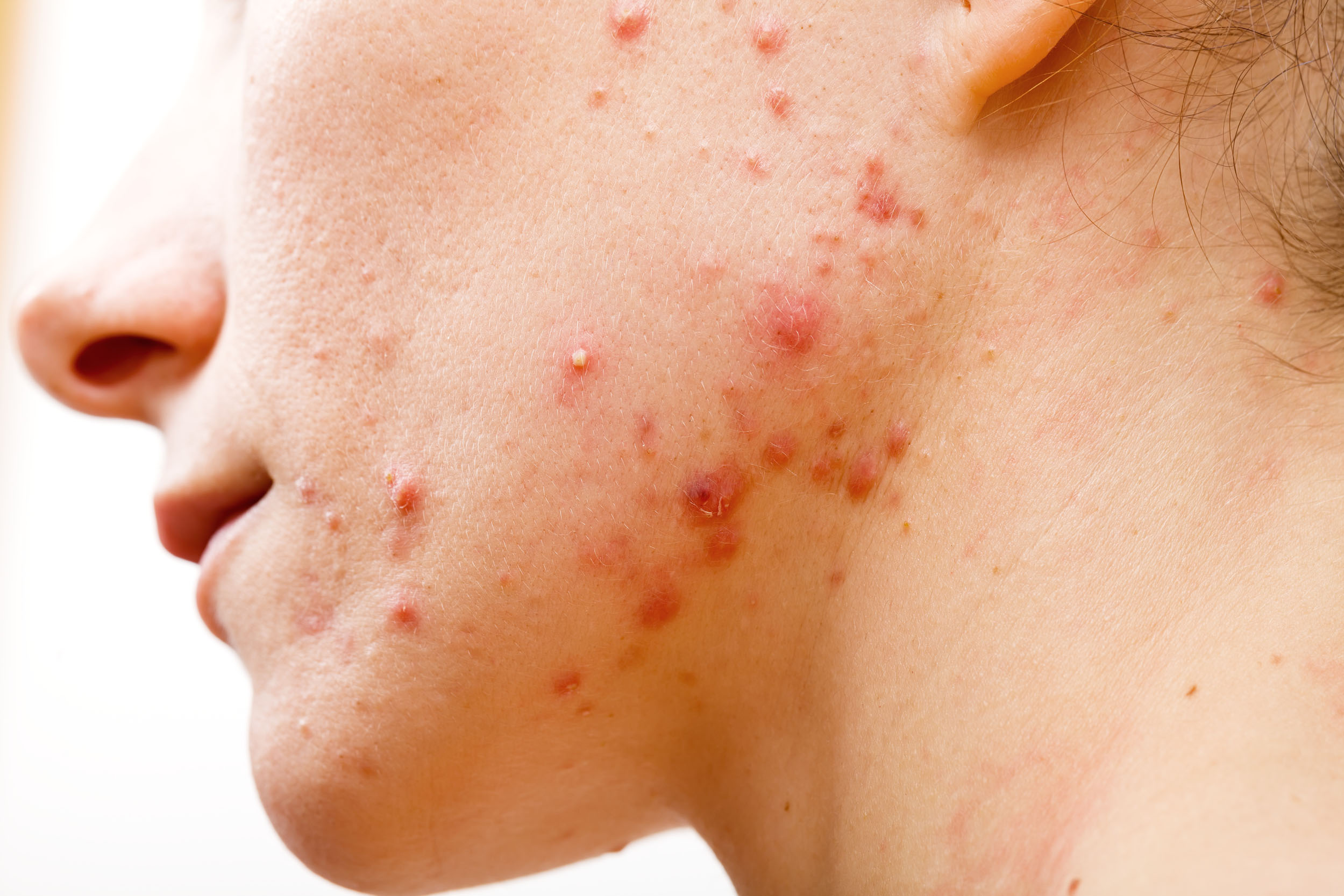 Acne is geen puberprobleem