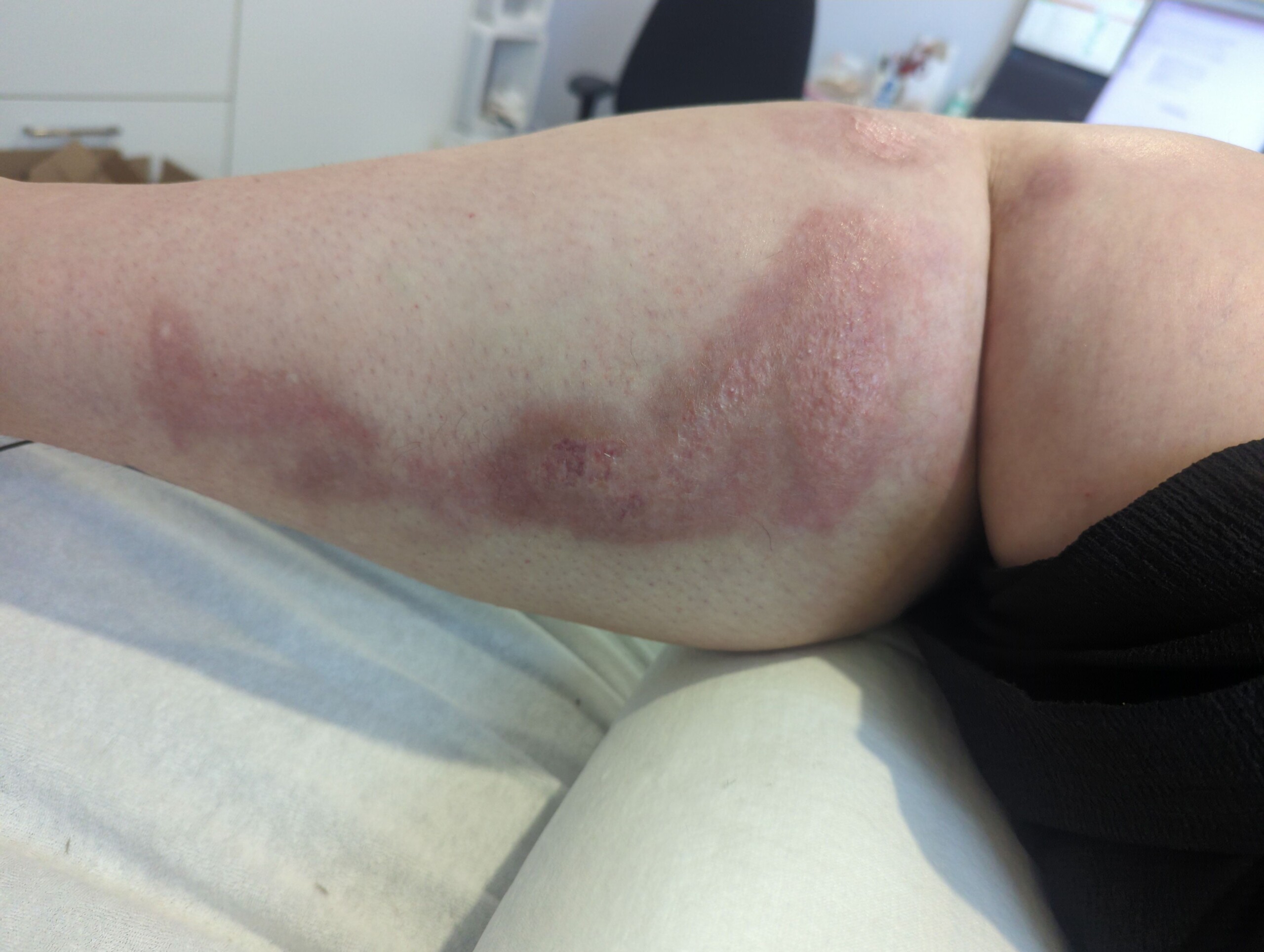 Behandeling van hypertrofisch brandwondenlitteken