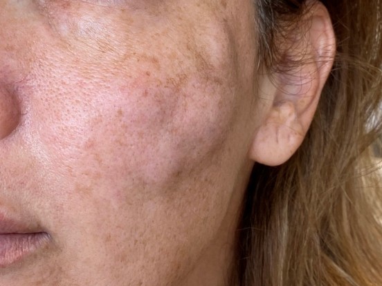 Fillers zijn populairder, meer complicaties